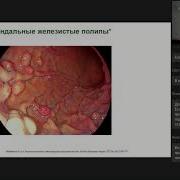 Гастрит И Язвенная Болезнь Современный Взгляд На Лечение И Профилактику